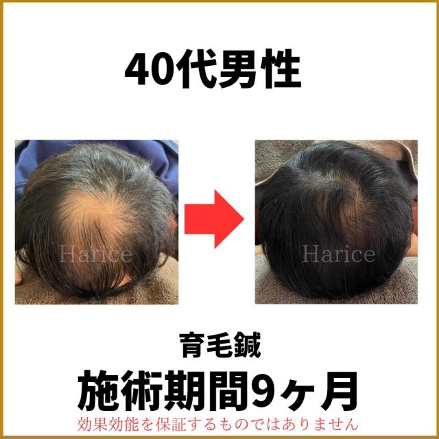 40代男性育毛鍼で薄毛改善9カ月