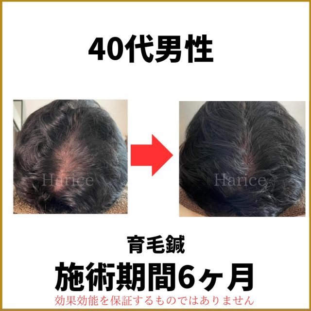40代男性育毛鍼で薄毛改善6カ月