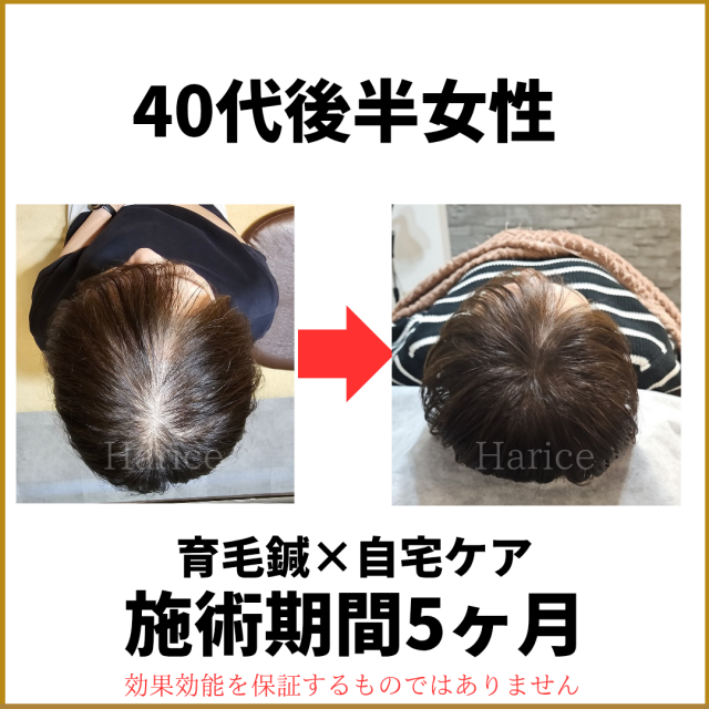 40代後半女性育毛鍼で薄毛改善5カ月