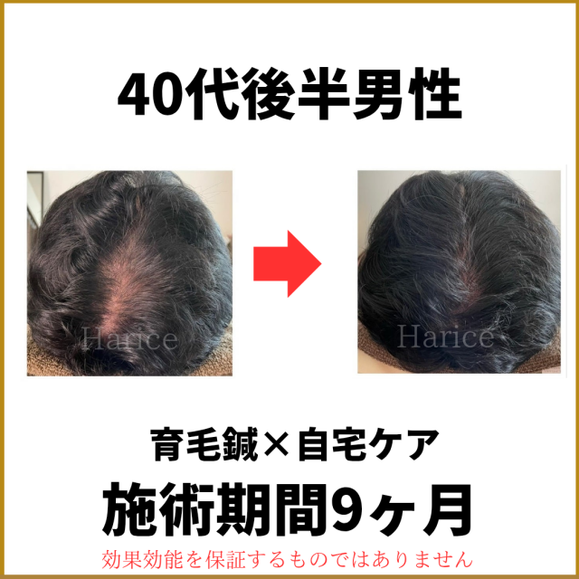 40代男性育毛鍼で円形脱毛症改善