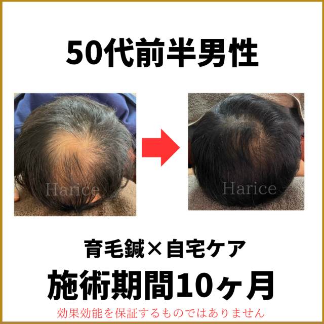 50代男性育毛鍼で薄毛改善