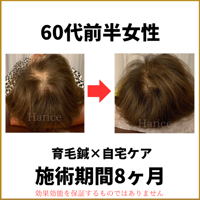 60代女性育毛鍼で薄毛改善
