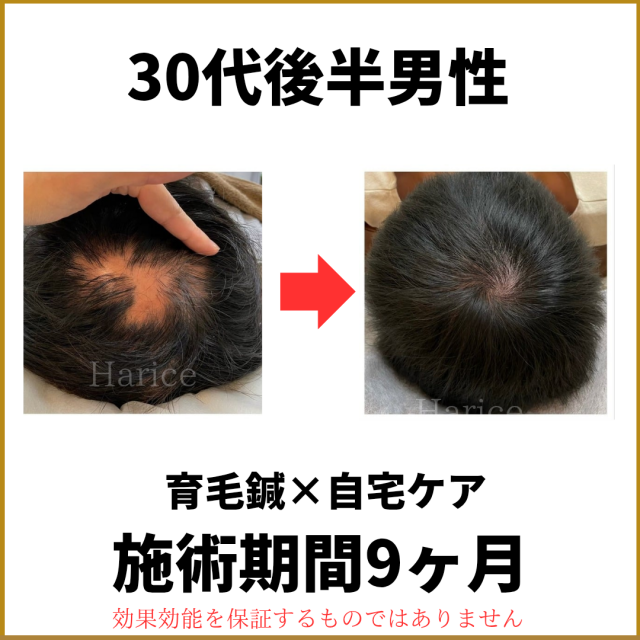 30代男性育毛鍼で薄毛改善